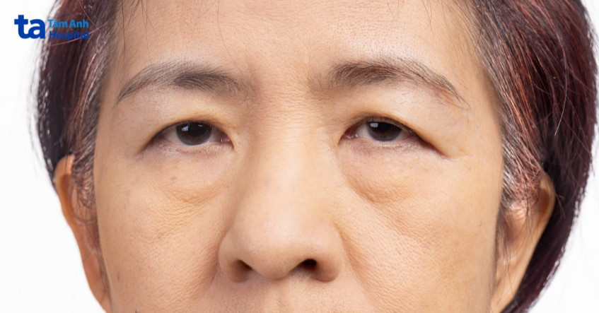 Mắt sụp mí là tình trạng mí mắt trên sa xuống gây cản trở tầm nhìn